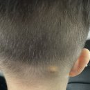 미래성형외과의원 | 27개월 아기 양성종양 제거 수술 후기(오체안성형외과의원)