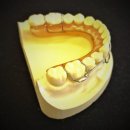 Just Fit 교정치과기공소 | 상,하악 Modified Wrap around Retainer (With. Adams Clasp)