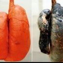 폐암의 민간 치료법 이미지