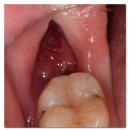 구리허브치과의원 | 구리사랑니치과 드라이소켓을 예방하려면