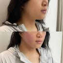 오름메디칼 | 경산피부관리 윤곽 리프팅, 더한오름에서 받은 진짜 관리 후기