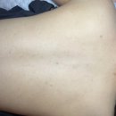 부건프라자 | 부천 등드름 관리 솔직후기 솔에스테틱 부천점