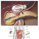 최장암/췌장암/이자암 검사방법 이미지
