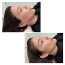 마리앤라인의원 | 이태원왁싱 | 헤어라인 정리로 이마 광명 찾기! 뷔쥬아 왁싱앤피부 후기