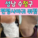 백피부과의원 | 성남피부과 편평사마귀 쥐젖 제거 후기 남편 목 피부 변화