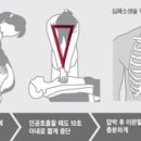 [심폐소생술]심장마비 환자 살리려면… 119 올 때까지 '흉부 압박'만이라도 하라 이미지