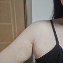 날개달린옷 | 미라드라이 당일 후기 : 시술 과정, 붓기, 통증 정리 + 직후 상태