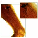 Re: 암전이 통로 'lymphatic system, sentinel lymph nodes' 실제 사진 이미지