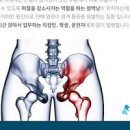 엉덩이가 아파요! 걸을 때 앉을 때 통증 원인 치료 이미지