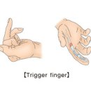 방아쇠수지 (Trigger Finger) 이미지