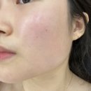 화정메디칼약국 | 스킨플래닝 / 내방동 피부관리 / 스킨플래닝 첫 후기, 스킨플래닝 뜻, 스킨플래닝 시술 시간, 스킨...