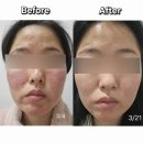 리나드림 | 결혼식전 2주만에 주사피부염 치료한 후기(내돈내산/수란트라크림/먹는약 처방)