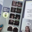 여자 머리 탈모 영양제 추천 후기 비오틴 맥주효모 탈모완화 효과