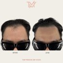 탈모왕수원