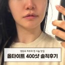 더400 | 영등포 피부과, 나는솔로리프팅 올타이트 400샷 후기(통증, 전후비교)