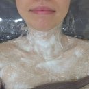 편평사마귀 '얼굴+목+상체' 제거 한달후 리터치 후기(전후비교, 비용)