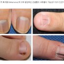 손발톱에 생겨난 세로줄, 괜찬을까? 이미지