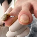 레푸스인하대역점 내성발톱 무좀발톱 발각질 문제성발 | [레푸스 인하대역점] 60대 여성 고객님, 층층이 쌓인 두꺼운 발톱완벽 스케일링 관리 후기