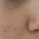 수진약국 | 점 빼고 올리브영 재생크림 아벤느 시칼파트sos 약국 연고 스티모린 내돈내산 추천