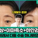 눈밑지방제거후 꺼졌던 눈밑과 주름을 해결하는 방법 대공개 #하안검 #재수술 #진피쿠션 이미지