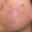 대인화장품 | 청소년 여드름 화장품 관리 후기 정착한 방법