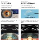 호호렌즈 | 강남 안과, EVO+아쿠아 ICL 후방렌즈 렌즈삽입술 후기