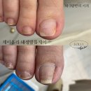 수원-1679 | 수원 내성발톱 케어 <제이올리에서>