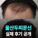 월드탑 | 울산두피문신 실제후기 이것만 보면 답 나옵니다