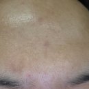 부천메디컬프라자 | 부천여드름관리 상동에스테틱 솔에스테틱 부천점 여드름솔루션케어(압출포함) 후기