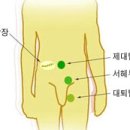 탈장이란? 이미지