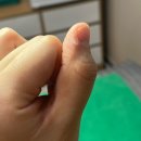 엘피스의원 | 손 사마귀 냉동치료 과정, 후기, 비용, 유의사항 ft.개롱역 엘피스 피부과 의원