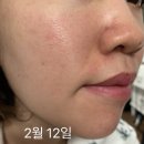 엘나인 | LED마스크 전용앰플 엘나인 2주 사용후기 / 펩타이드 성분으로 피부 탄력 모공관리 해요!