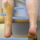 레이즈스포츠농구 | 아킬레스건 파열(Achilles Tendon Rupture)
