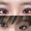 대구성형외과 부분절개+눈매교정 쌍수후기(가격 붓기 흉터 관리)