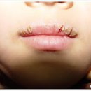 박탈성 구순염 연고 치료, 원인 (탈락성입술염, 입술 염증 각질 수포) 이미지