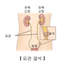 대원나무종합병원 | 극심한 옆구리 통증을 수반하는 요로결석 ㅜㅜ / 치료과정과 치료비용 및 예방수칙