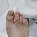 레푸스 구월점 내성발톱 무좀발톱 발각질 문제성발 이미지