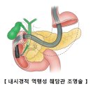 담낭암(GB cancer) 이미지