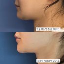 2 | 이중턱지방흡입 효과본 2달후기