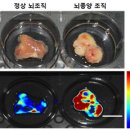 뇌종양, 이젠 5분 이내에 신속하고 정확하게 진단한다 이미지