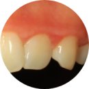 [CCL잇몸성형]잇몸전문 CCL치과