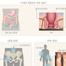 크론병 및 원인과 진단 유무 음식 이미지