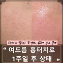 뉴에어프락셀 1주차 후기 | 딱지 언제 떨어질까? 붉은기·메디덤 제거 후 재생 관리까지