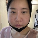 차좀볼줄압니더 | 안면윤곽 3종+앞턱전진+귀족수술 내돈내산 리얼 후기 [수술 4-5일차]