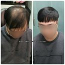더리터한민 | 머리숱없는 결혼식 남자 머리 증모술이면 걱정없다. 강남증모술 시술후기