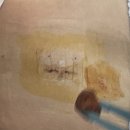 허리디스크 수술 3개월 후기 수술비 70대