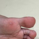 발가락사마귀/족저사마귀 베루말 및 냉동치료 제거 후기