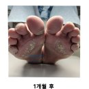 메트로피부과의원 | “무좀에서 봉와직염까지, 치유본의원한의원이 만든 놀라운 변화 – [파주]일산 발톱무좀 치료 후기