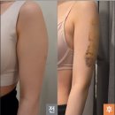 동멍약국 | 예신의 팔뚝 무한람스 365mc 교대점 찐후기] - 당일~1개월차 후기, 부작용, 통증, 후관리, 일상관리 공유