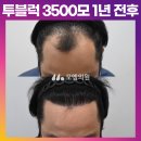 [40대 남자 C자탈모 헤어라인 머리심기] 비절개 투블럭 모발이식 3500모 1년 후기 (모엠의원/C자탈모/전지훈원장) 이미지